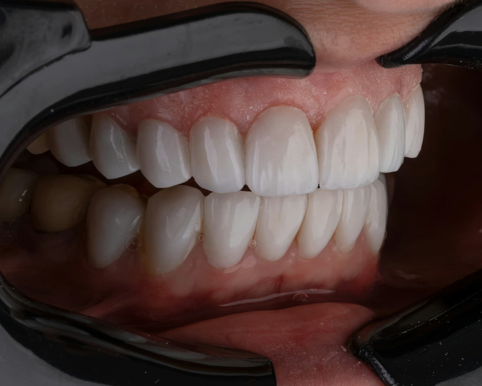 Veneers